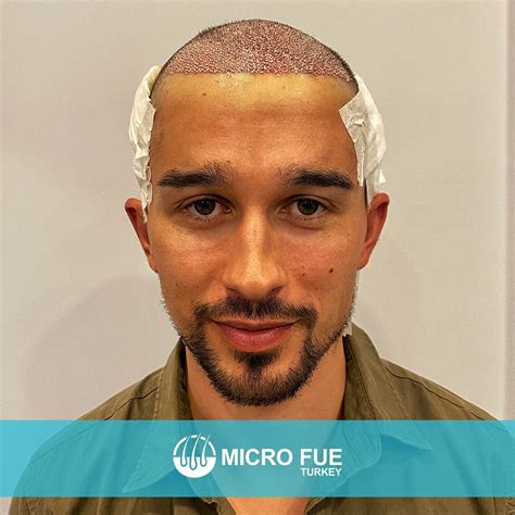 istanbul hair transplant reviews